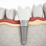 dental implants at route 66 smiles family dentistry