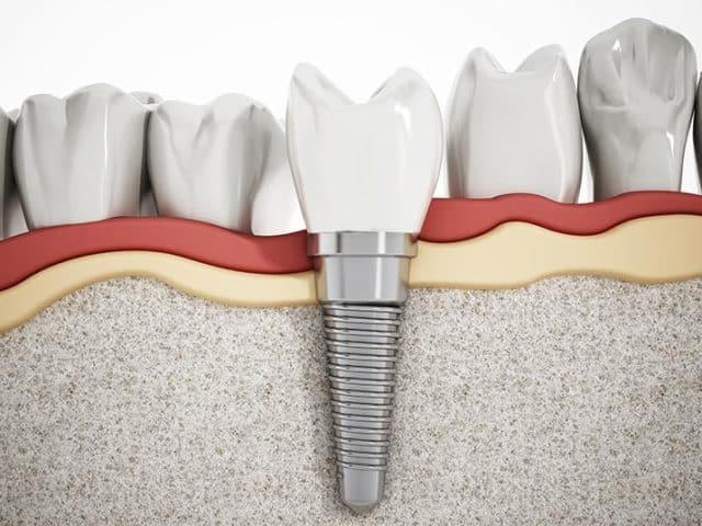 Understand the Basics: A Comprehensive Guide to Dental Implants